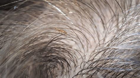 Does Hair Dye Kill Lice Or Their Eggs Complete Guide