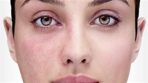 How To Get Rid Of Redness On Face Causes Of Redness On Face Youtube