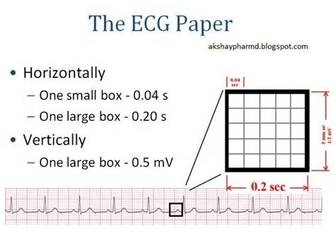 Simple Explanation Of The Ecg Graph Paper Ekg Interpretation Ecg