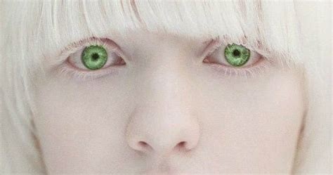 Bee Simply Amazing The Throes Of A Green Eyed Albino Girl