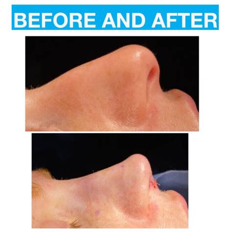 An After Rhinoplasty Result For A Newmarket Patient With A Crooked Nose A Dorsal Hump And A