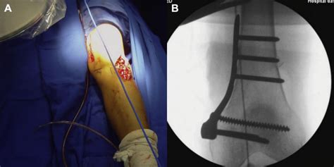 Medial Closing Wedge Distal Femoral Osteotomy Fixation With Proximal