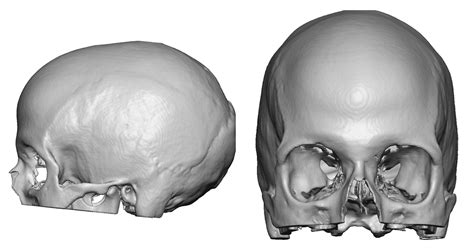 Blog Archivecase Study Two Stage Skull Augmentation With Custom