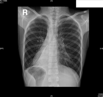 Dextrocardia with situs inversus is a condition that is characterized by abnormal positioning of the heart and other internal organs. Internet Scientific Publications