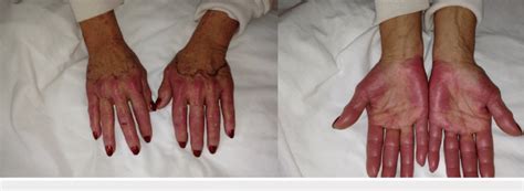 Dorsal And Plantar View Of Both Hands Showing Erythema And Swelling