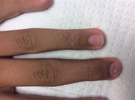 Acral Flesh Colored Papules On The Fingers Mdedge Dermatology