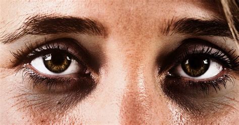 Dark Circles Under The Eyes Causes And Treatments