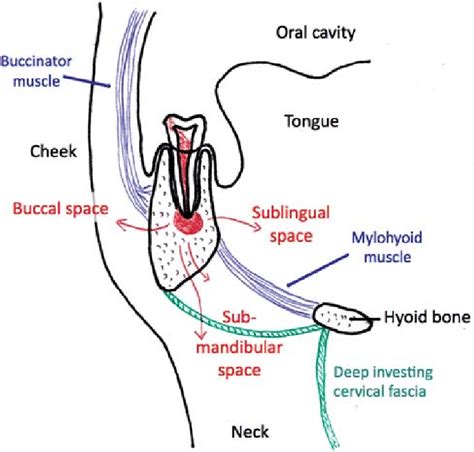 Coronal Section Of Right Mandible Showing Potential Paths Of Spread Of