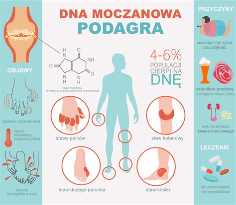 Podagra dna moczanowa Przyczyny objawy i leczenie skutków podagry