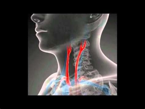 Cervical artery dissection is a dissection of any of the arteries in the neck. Symptoms of Blocked Arteries in Neck - YouTube | Test arteries clogged? | Pinterest | Watches ...
