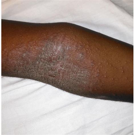 Diffuse Poorly Demarcated Erythematous Papules With Secondary Infection