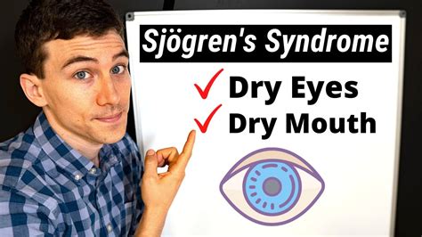 What Is Sjögrens Syndrome Eye Doctor Explains