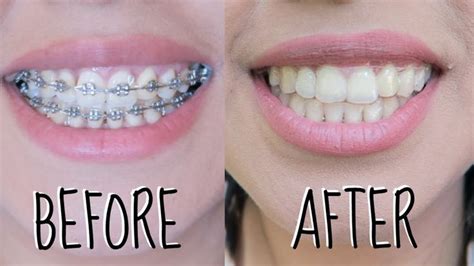 How Do Braces Work For Gaps Elroy Slone