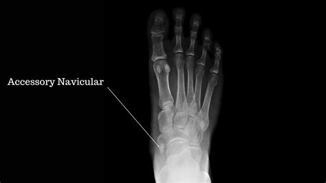Accessory Navicular Syndrome Prevalance Causes And Treatment