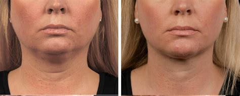 Coolsculpting For A Double Chin London Premier Laser Clinic