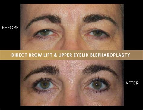 Brow Forehead Lift Photos Plastic Eye Surgery Associates