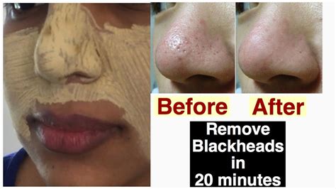 How To Shrink Pores After Blackhead Extraction The Beautious