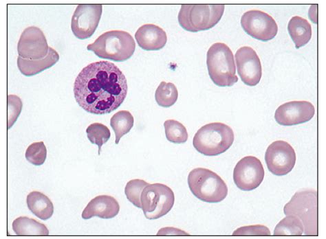 Poikilocytosis Variation In Shape Of Red Cells Abnormally Shaped