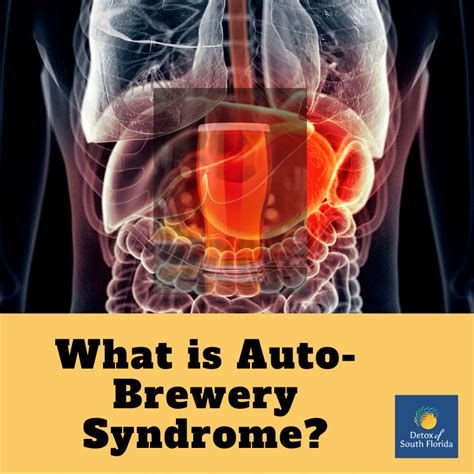 auto brewery syndrome in addiction