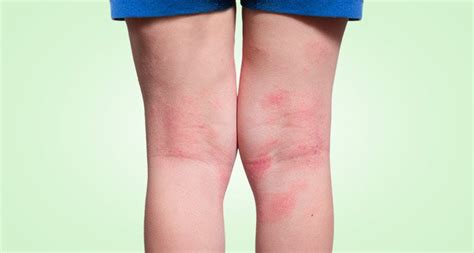 What Is Eczema Understanding And Treating Eczema Symptoms Lovelyskin™