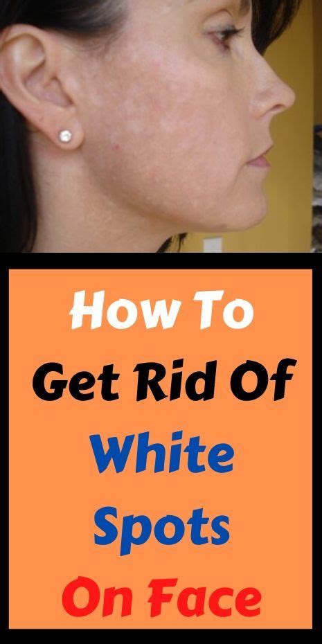 How To Get Rid White Spots On Face And Its Causes Manchas Manchas My