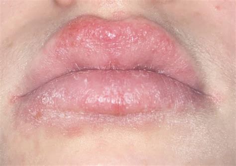 Red Bumpy Raw Scaly Rash On And Around Lips Rdermatology