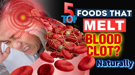 Top Foods That Melt Blood Clots Naturally Foods That Dissolve Blood