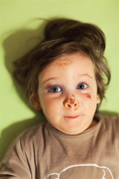 Baby With Bruises Stock Image Image Of Making Injury 44372673
