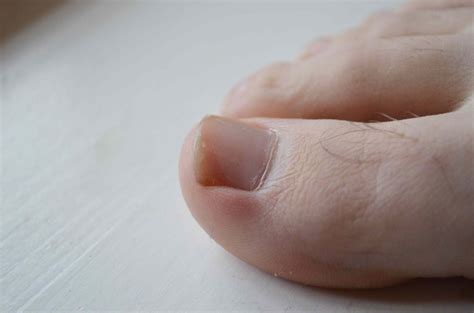 An Overview Of Common Toenail Problems Nutrition Line