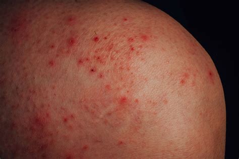 Atopic Dermatitis Is Diagnosed Using The Major And Minor Features Of