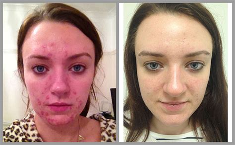 Grafik Offizier Frustration laser against acne dramatisch Keil Verzweifelt