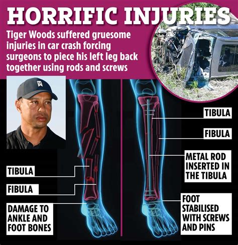 Tiger Woods Leg Injury Surgery Tiger Woods Manager Golf Star Suffered
