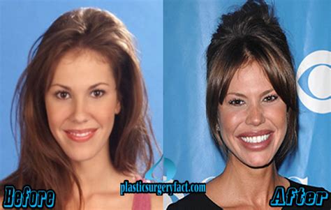 Botched Plastic Surgery Photos Before And After Plastic