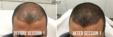 Scalp Micropigmentation SMP for Long Hair in Birmingham UK ...