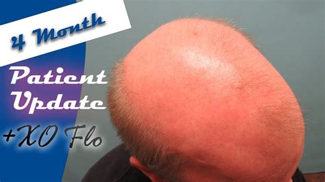 Norwood 7 Hair Loss Treatment Patient Update With Adam Youtube