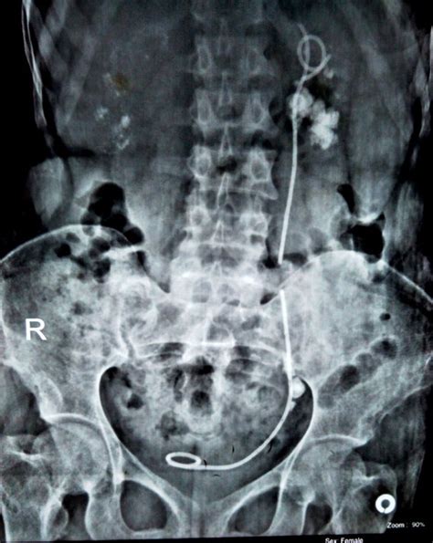 X Ray Kub Revealed Bilateral Multiple Radio Opaque Shadows In Kidneys