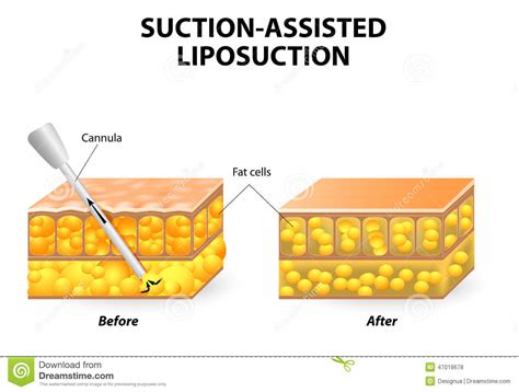 Liposuction Stock Vector Image 47018678