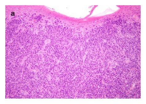 A Dense Dermal Atypical Lymphocytic Infiltrate With Mild