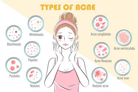 The Different Types Of Acne And Their Treatments Dallasjobsonline