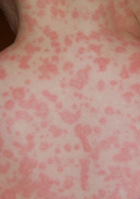 How To Tell If A Rash Needs Medical Attention Alaska