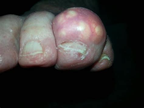 Gout Gouty Arthritis Podegra Arthritis Big Toe Pain Foot