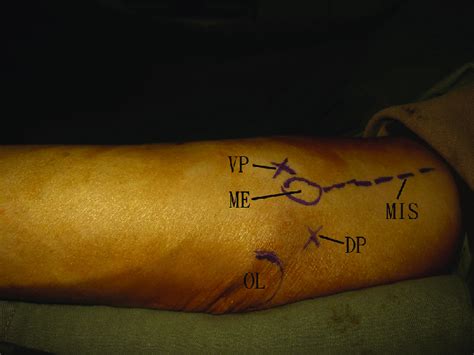 Endoscopic Anterior Subcutaneous Transposition Of The Right Ulnar