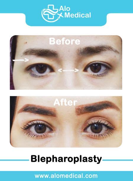Blepharoplasty Eyelid Surgery In Iran Best Hospitals Cost