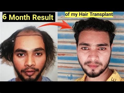 Month Results Of My Hair Transplant GaneshThakur Best Hair Transplant Results YouTube