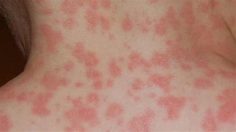 Allergic Reaction Rash Pictures Rashes Can Appear As Blotches Welts