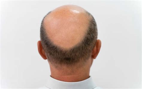 7 Penyebab Rambut Botak Yang Harus Diwaspadai Penting