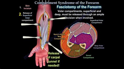 Compartment Syndrome Of The Forearm Everything You Need To Know Dr