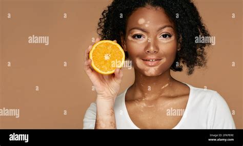 Beauty Skin Care Woman With Problem Skin Holds Orange Near A Face With Vitiligo Over Light