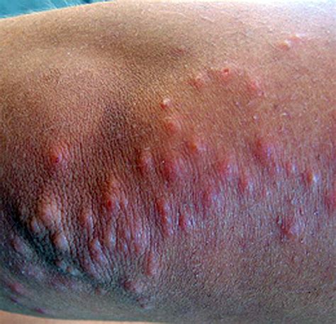 What Does Bed Bug Bites On Black People Skin Y L P C