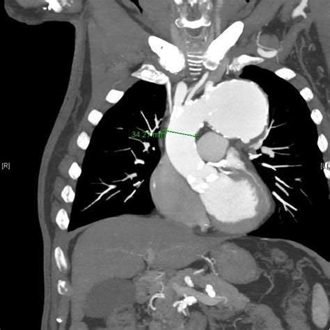 Preoperative Enhanced Ct Scan Showing The Aortic Arch Aneurysm